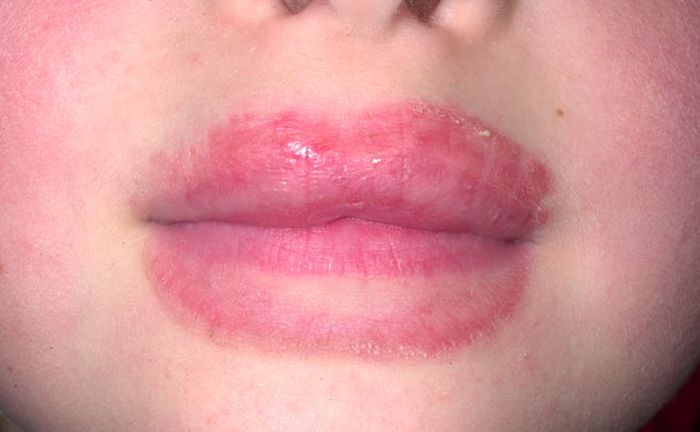 Allergic Contact Dermatitis - skinsight